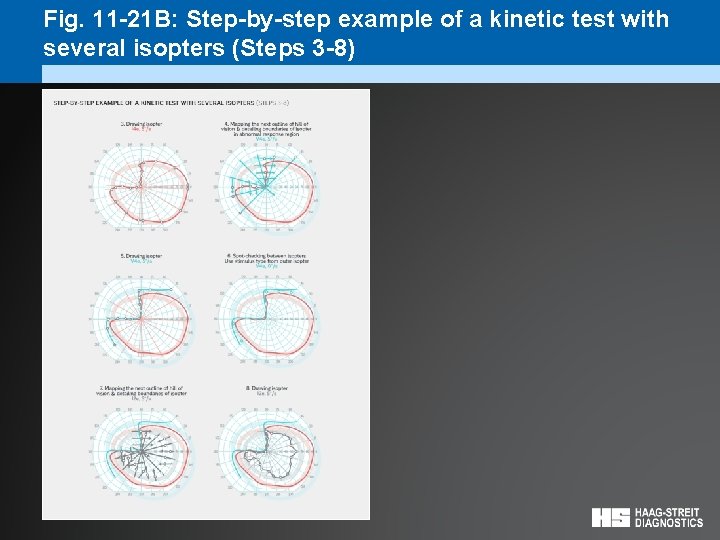 Fig. 11 -21 B: Step-by-step example of a kinetic test with several isopters (Steps