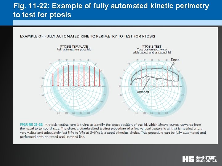 Fig. 11 -22: Example of fully automated kinetic perimetry to test for ptosis 