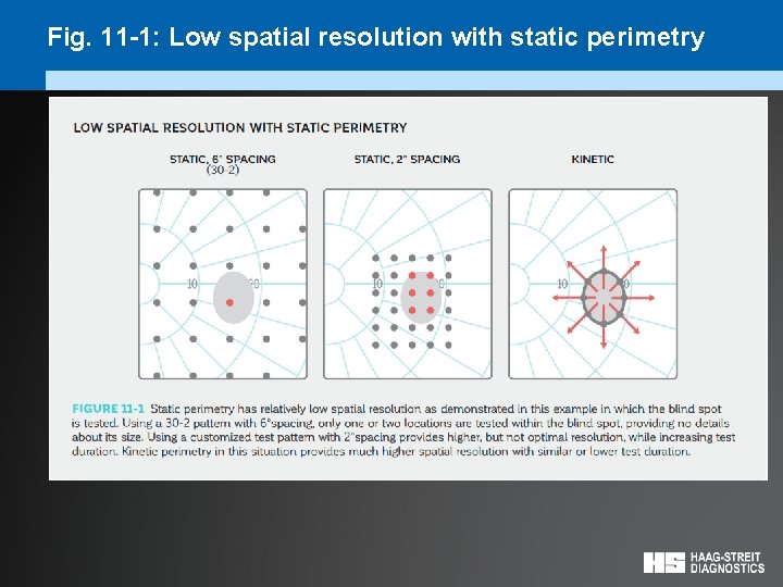 Fig. 11 -1: Low spatial resolution with static perimetry 