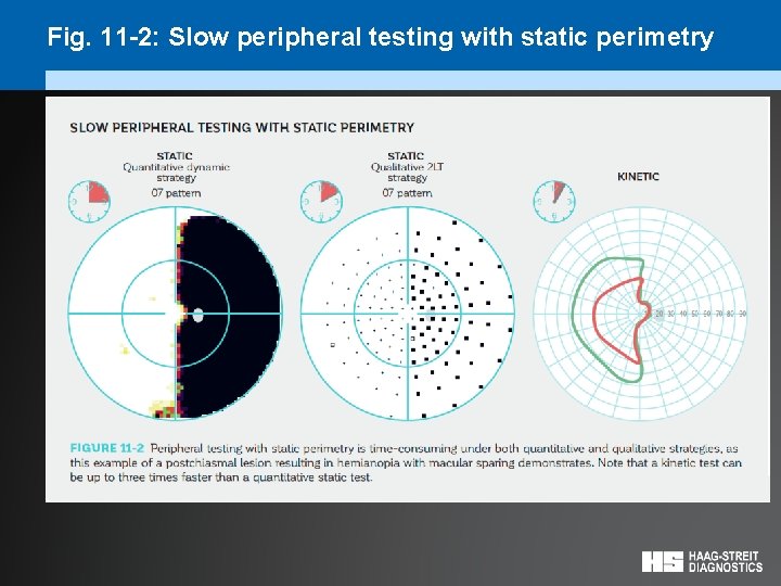 Fig. 11 -2: Slow peripheral testing with static perimetry 