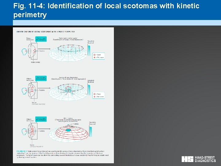 Fig. 11 -4: Identification of local scotomas with kinetic perimetry 