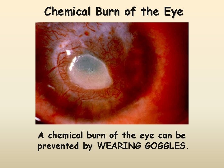 Chemical Burn of the Eye A chemical burn of the eye can be prevented