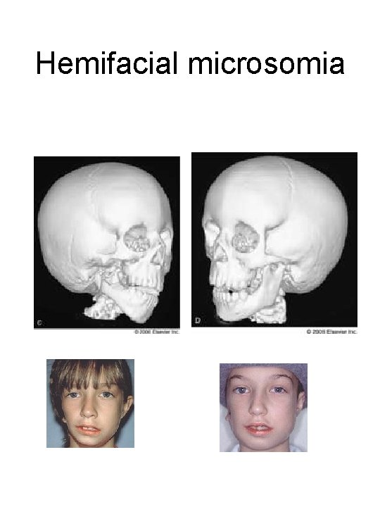 Hemifacial microsomia 