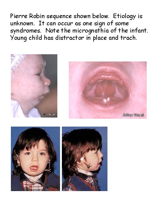 Pierre Robin sequence shown below. Etiology is unknown. It can occur as one sign