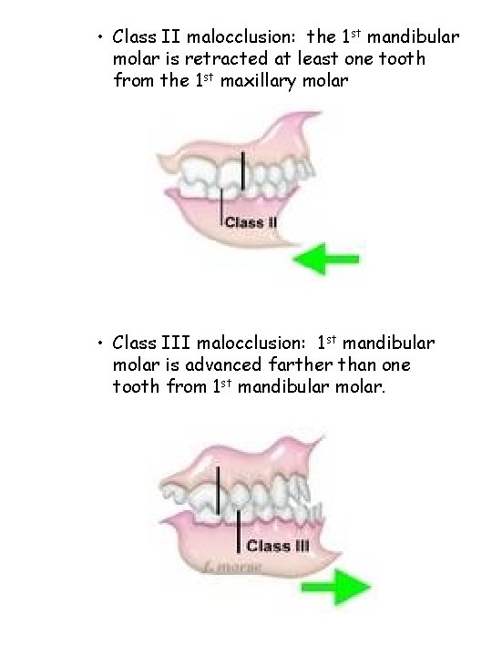  • Class II malocclusion: the 1 st mandibular molar is retracted at least