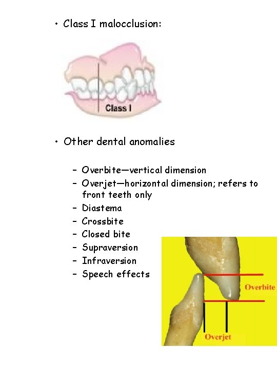  • Class I malocclusion: • Other dental anomalies – Overbite—vertical dimension – Overjet—horizontal