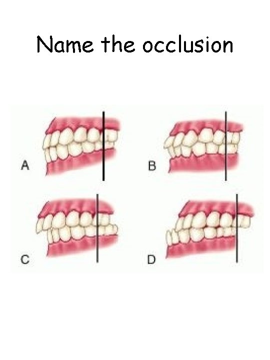 Name the occlusion 