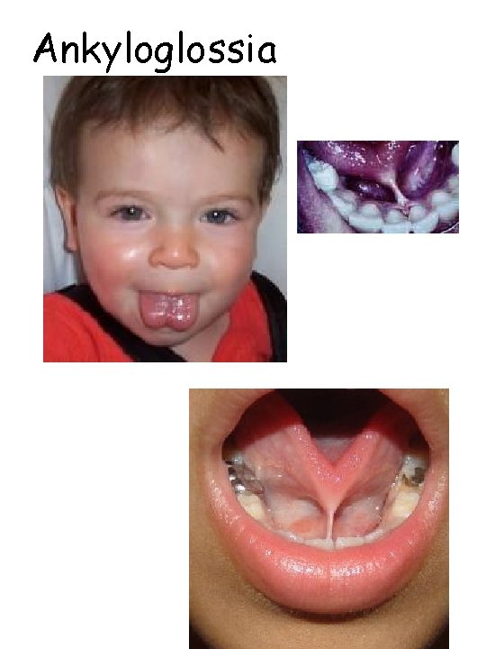 Ankyloglossia 