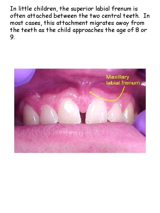 In little children, the superior labial frenum is often attached between the two central