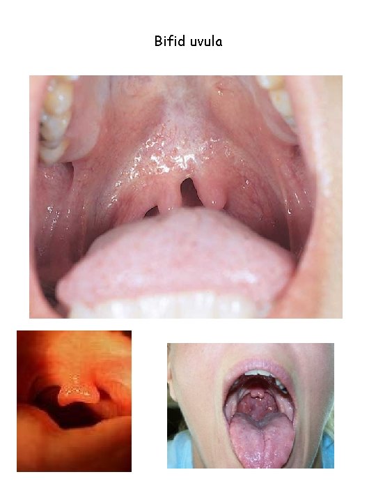 Bifid uvula 