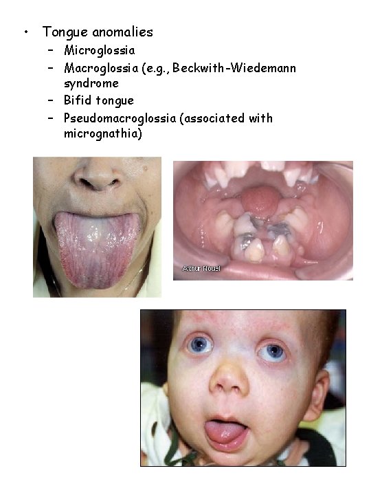  • Tongue anomalies – Microglossia – Macroglossia (e. g. , Beckwith-Wiedemann syndrome –