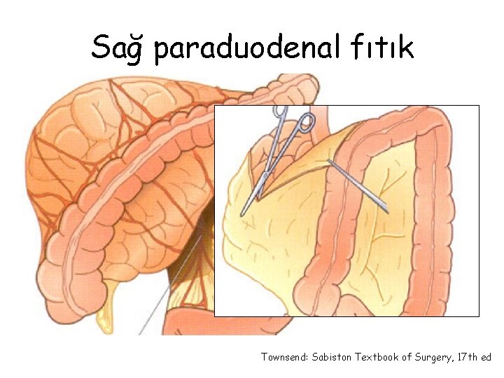 Sağ paraduodenal fıtık Townsend: Sabiston Textbook of Surgery, 17 th ed 