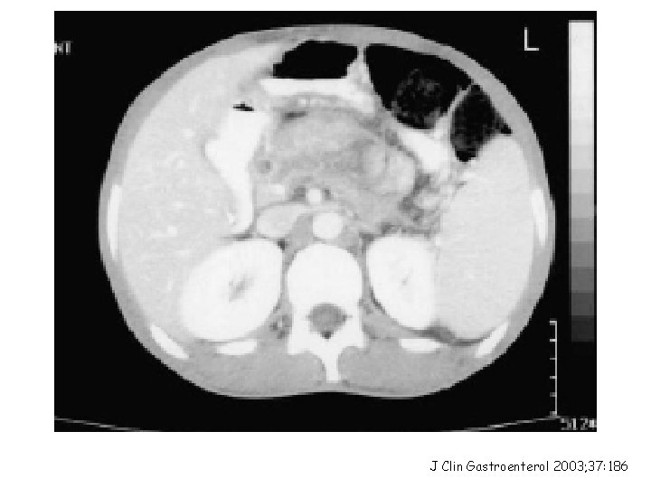 J Clin Gastroenterol 2003; 37: 186 