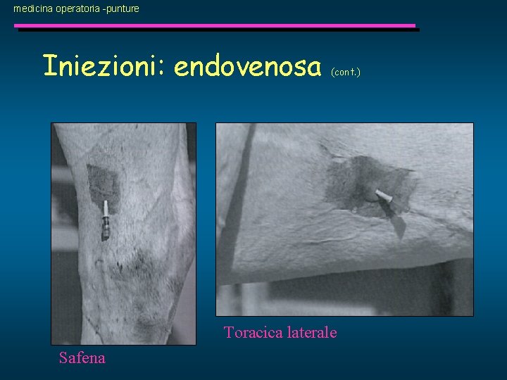medicina operatoria -punture Iniezioni: endovenosa (cont. ) Toracica laterale Safena 