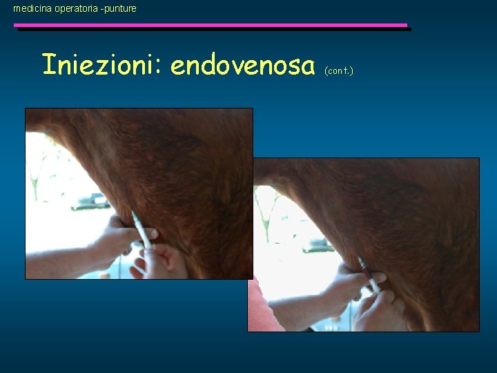 medicina operatoria -punture Iniezioni: endovenosa (cont. ) 