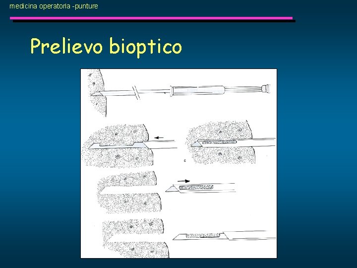 medicina operatoria -punture Prelievo bioptico 