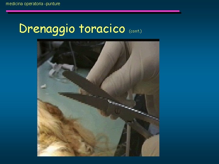 medicina operatoria -punture Drenaggio toracico (cont. ) 