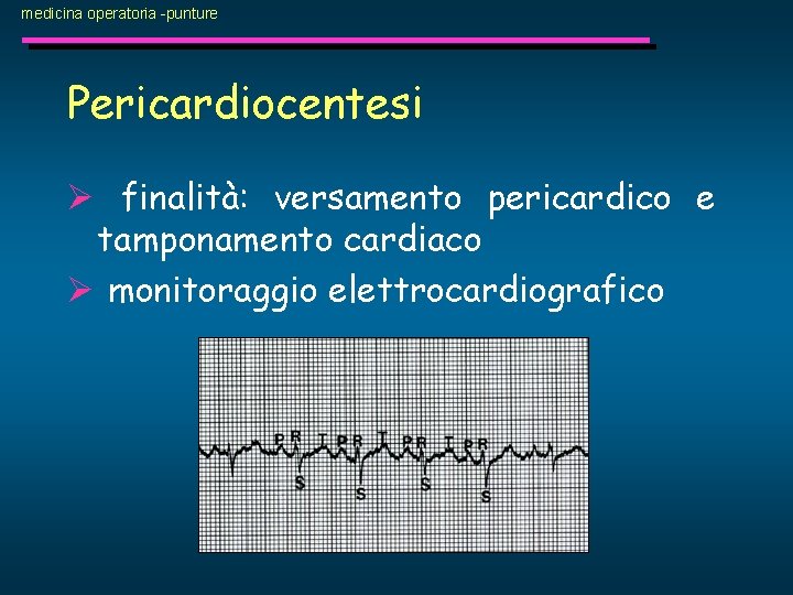 medicina operatoria -punture Pericardiocentesi Ø finalità: versamento pericardico e tamponamento cardiaco Ø monitoraggio elettrocardiografico