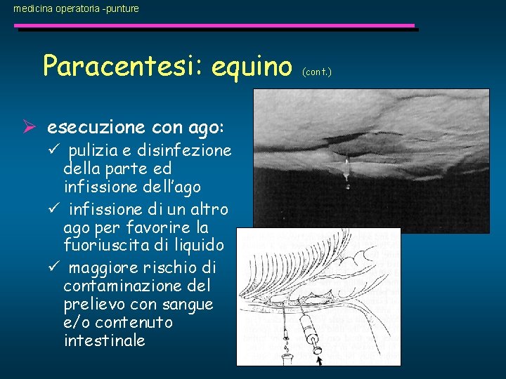 medicina operatoria -punture Paracentesi: equino Ø esecuzione con ago: ü pulizia e disinfezione della