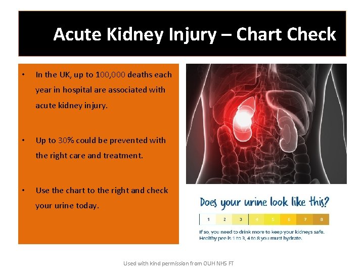 Acute Kidney Injury – Chart Check • In the UK, up to 100, 000