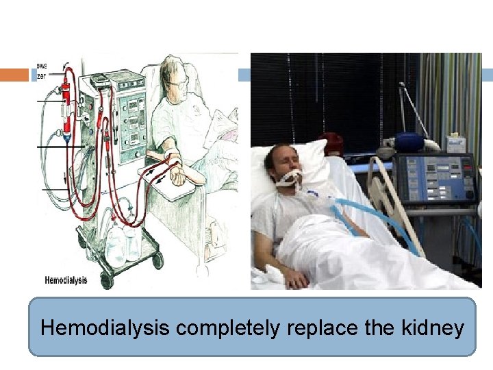 Hemodialysis completely replace the kidney 