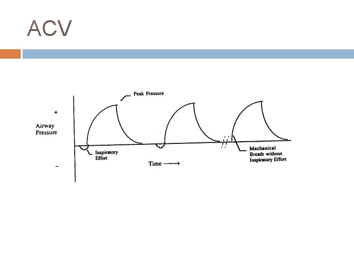 ACV 