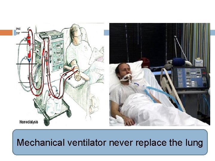 Mechanical ventilator never replace the lung 