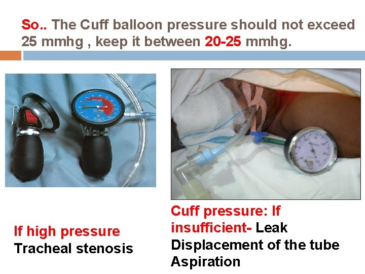 So. . The Cuff balloon pressure should not exceed 25 mmhg , keep it