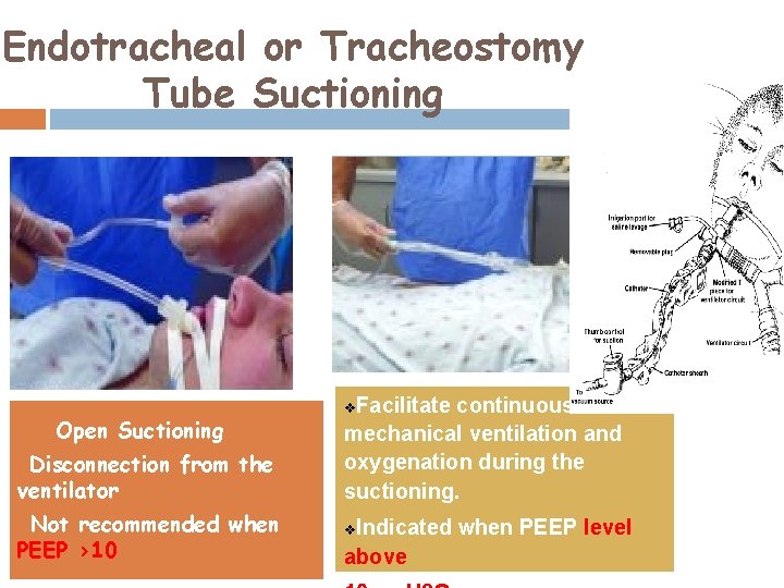 Endotracheal or Tracheostomy Tube Suctioning Closed Suctioning: Open Suctioning Disconnection from the ventilator v