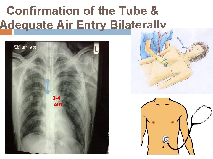 Confirmation of the Tube & Adequate Air Entry Bilaterally 3 -4 cm 