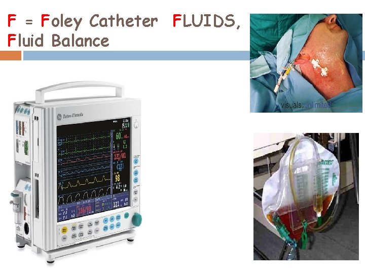 F = Foley Catheter FLUIDS, Fluid Balance 