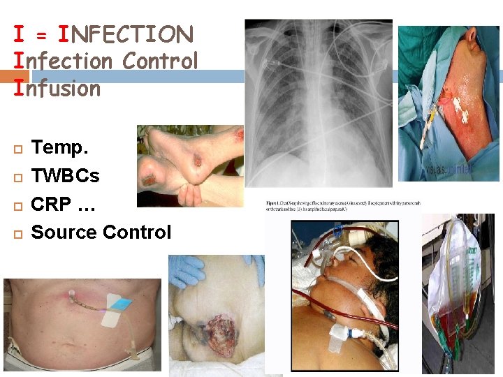 I = INFECTION Infection Control Infusion Temp. TWBCs CRP … Source Control 
