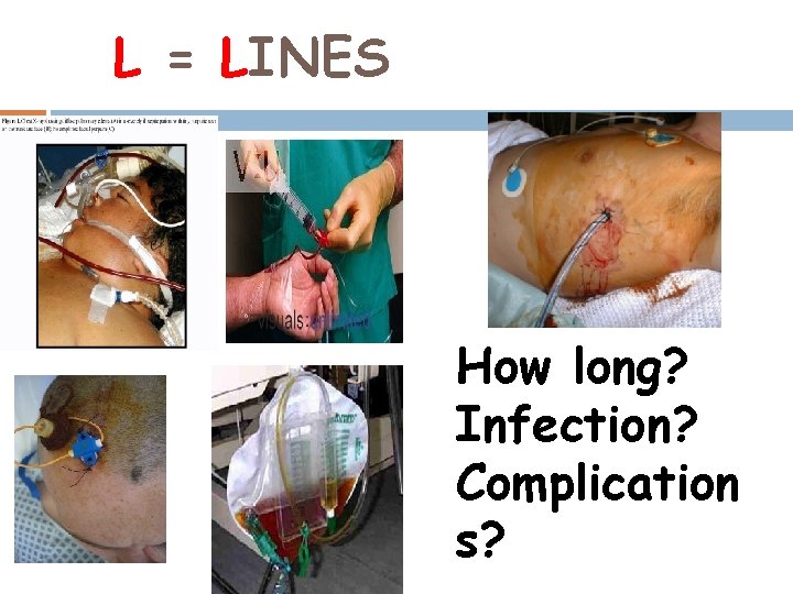 L = LINES How long? Infection? Complication s? 