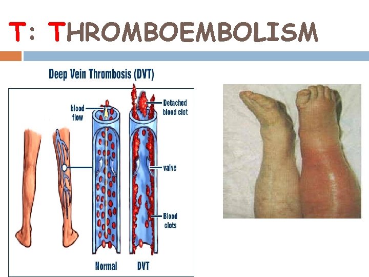 T: THROMBOEMBOLISM 