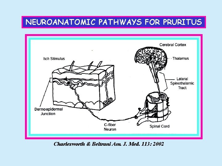 NEUROANATOMIC PATHWAYS FOR PRURITUS Charlesworth & Beltrani Am. J. Med. 113: 2002 