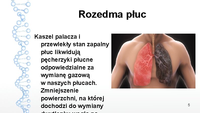 Rozedma płuc Kaszel palacza i przewlekły stan zapalny płuc likwidują pęcherzyki płucne odpowiedzialne za