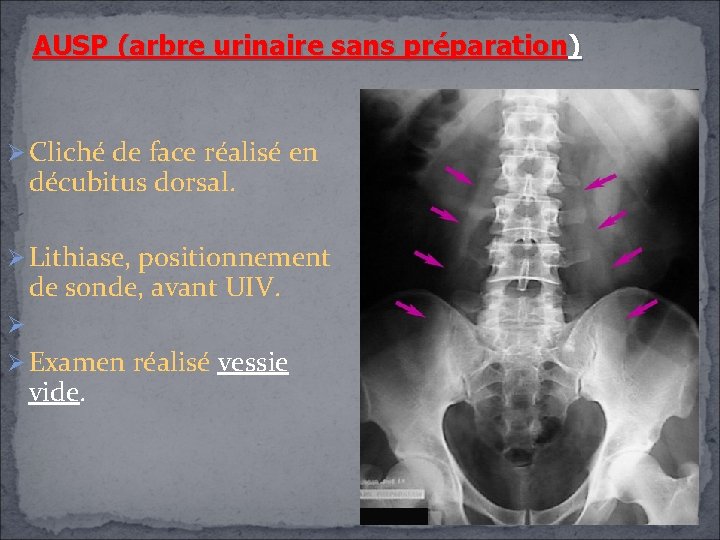 AUSP (arbre urinaire sans préparation) Cliché de face réalisé en décubitus dorsal. Lithiase, positionnement AUSP (arbre urinaire sans préparation) Cliché de face réalisé en décubitus dorsal. Lithiase, positionnement