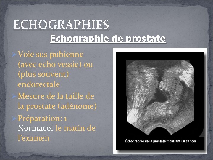 ECHOGRAPHIES Echographie de prostate Voie sus pubienne (avec echo vessie) ou (plus souvent) endorectale ECHOGRAPHIES Echographie de prostate Voie sus pubienne (avec echo vessie) ou (plus souvent) endorectale