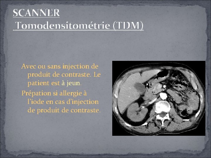 SCANNER Tomodensitométrie (TDM) Avec ou sans injection de produit de contraste. Le patient est SCANNER Tomodensitométrie (TDM) Avec ou sans injection de produit de contraste. Le patient est