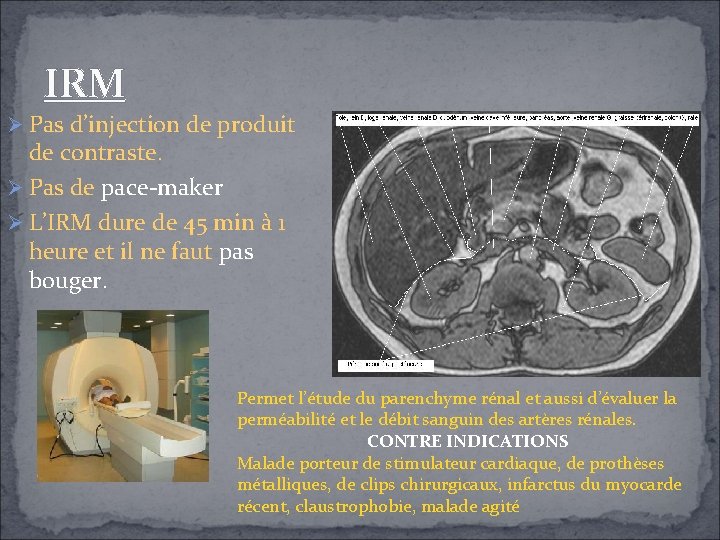 IRM Pas d’injection de produit de contraste. Pas de pace-maker L’IRM dure de 45 IRM Pas d’injection de produit de contraste. Pas de pace-maker L’IRM dure de 45