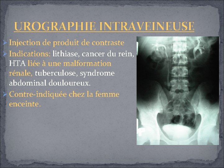 UROGRAPHIE INTRAVEINEUSE Injection de produit de contraste Indications: lithiase, cancer du rein, HTA liée UROGRAPHIE INTRAVEINEUSE Injection de produit de contraste Indications: lithiase, cancer du rein, HTA liée