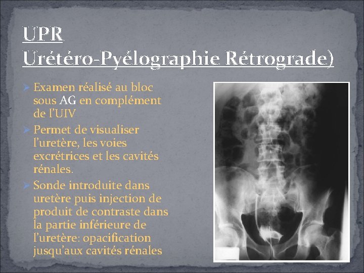 UPR Urétéro-Pyélographie Rétrograde) Examen réalisé au bloc sous AG en complément de l’UIV Permet UPR Urétéro-Pyélographie Rétrograde) Examen réalisé au bloc sous AG en complément de l’UIV Permet