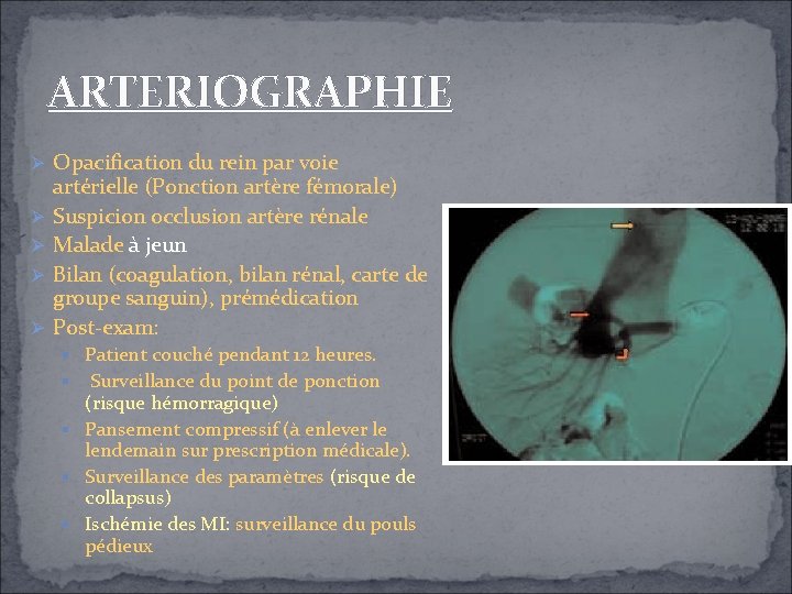 ARTERIOGRAPHIE Opacification du rein par voie artérielle (Ponction artère fémorale) Suspicion occlusion artère rénale ARTERIOGRAPHIE Opacification du rein par voie artérielle (Ponction artère fémorale) Suspicion occlusion artère rénale