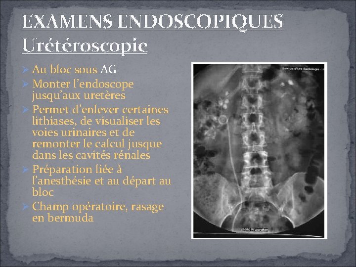 EXAMENS ENDOSCOPIQUES Urétéroscopie Au bloc sous AG Monter l’endoscope jusqu’aux uretères Permet d’enlever certaines EXAMENS ENDOSCOPIQUES Urétéroscopie Au bloc sous AG Monter l’endoscope jusqu’aux uretères Permet d’enlever certaines