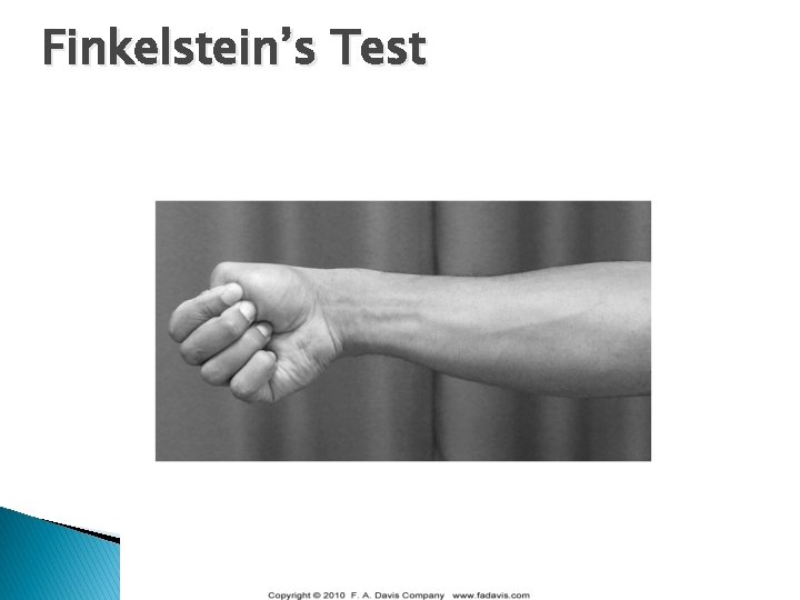 Finkelstein’s Test 