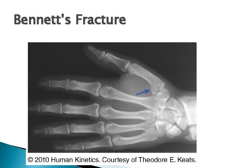 Bennett’s Fracture 