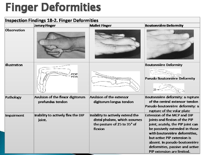 Finger Deformities 