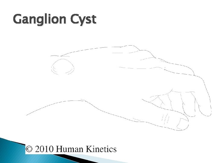 Ganglion Cyst 