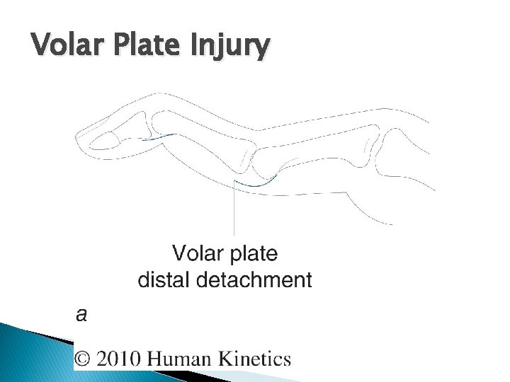 Volar Plate Injury 