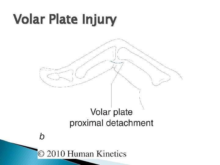 Volar Plate Injury 